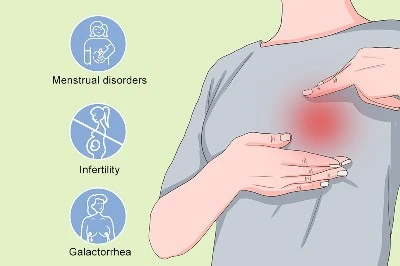 Hyperprolactinemia Hyperprolactinemia