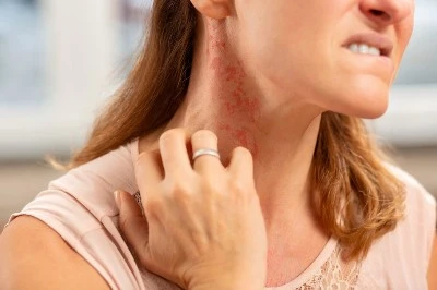 Skin Irritation Skin Irritation