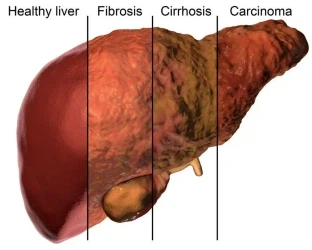 Liver Fibrosis Liver Fibrosis